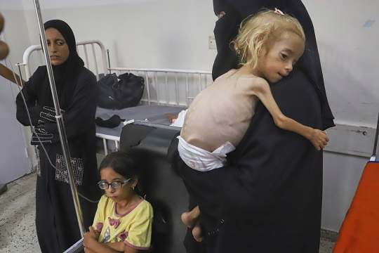 Gaza doctors bony limbs